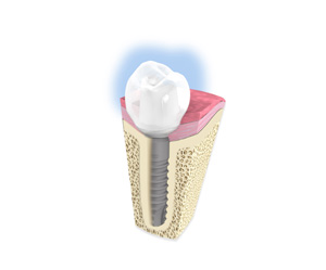 Implant Dentaire Plérin